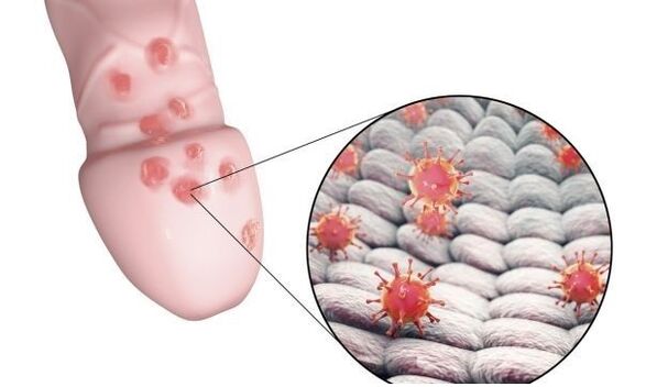 alergia ao gel para aumentar o pênis