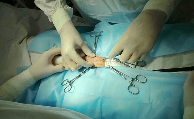 A cirurgia no órgão reprodutor ajudará a aumentar seu tamanho